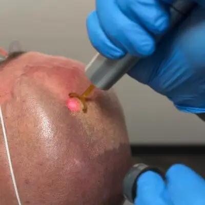 Laser SMP Removal with the PicoWay at Studio Kiku