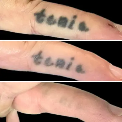 Finger tattoo removal results