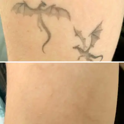 successful fine line tattoo removal with the PicoWay at Studio Kiku