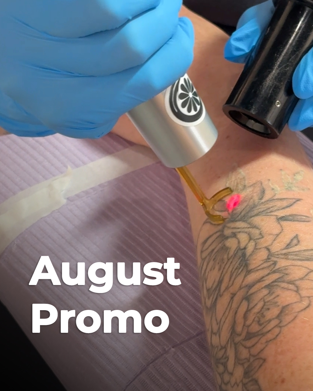 Complete Tattoo Removal Package - August Promo