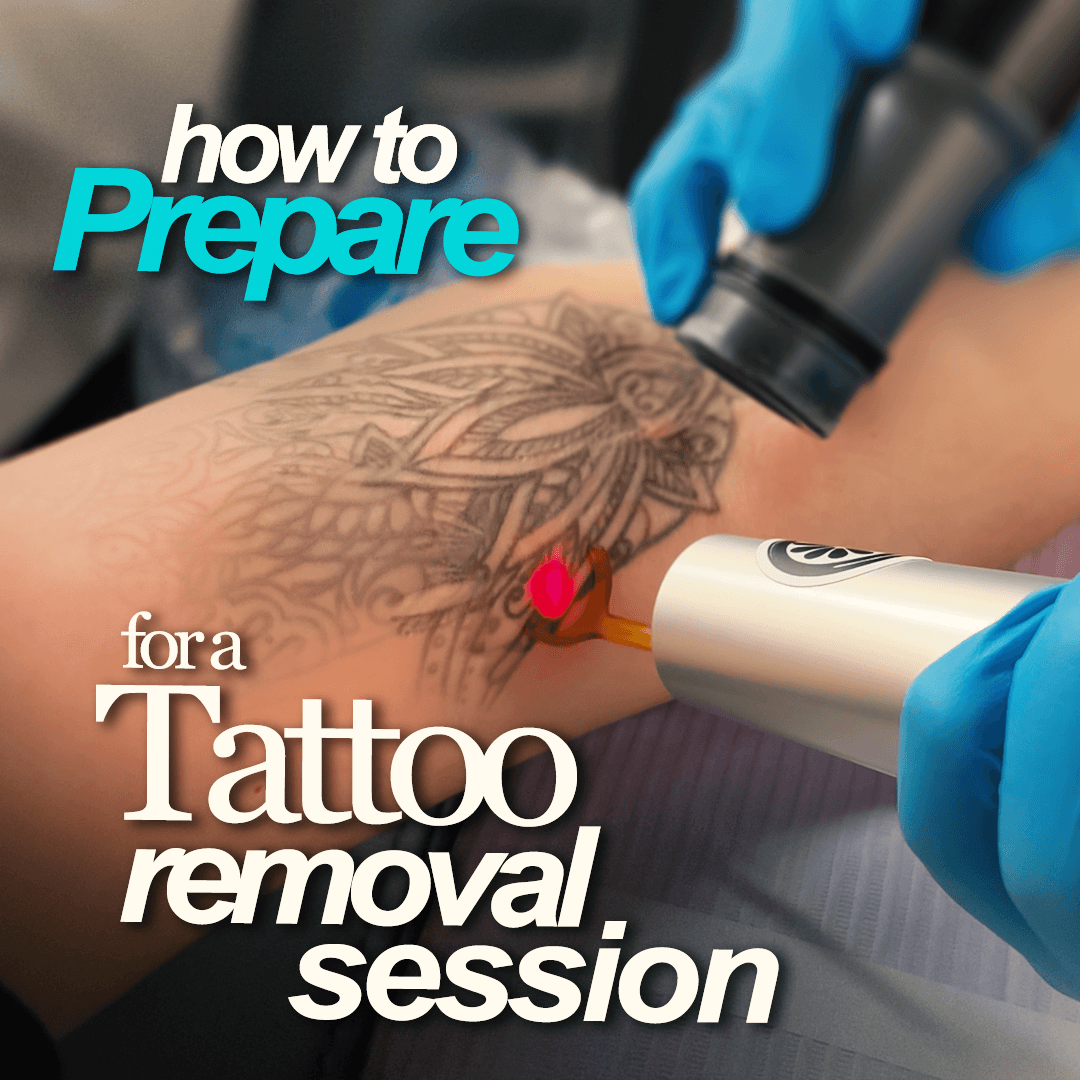 How to Prepare for Laser Tattoo Removal